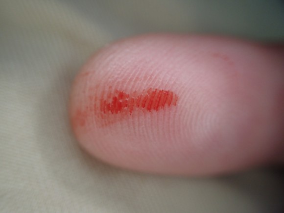 人間の血を吸った蚊を駆除した後に指についた赤い血液
