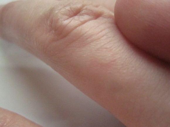 害虫の蚊・ヒトスジシマカに刺されて腫れた指の写真画像