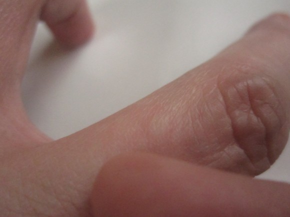 害虫の蚊・ヒトスジシマカに刺されて腫れた指の写真画像
