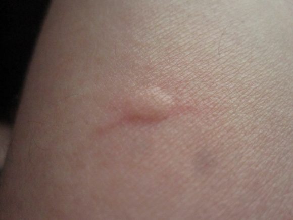 害虫の蚊（ヒトスジシマカ）に刺され血を吸われた後の皮膚の膨疹