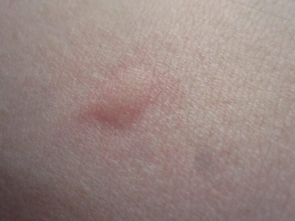 害虫の蚊（ヒトスジシマカ）に刺され血を吸われた後の皮膚の膨疹