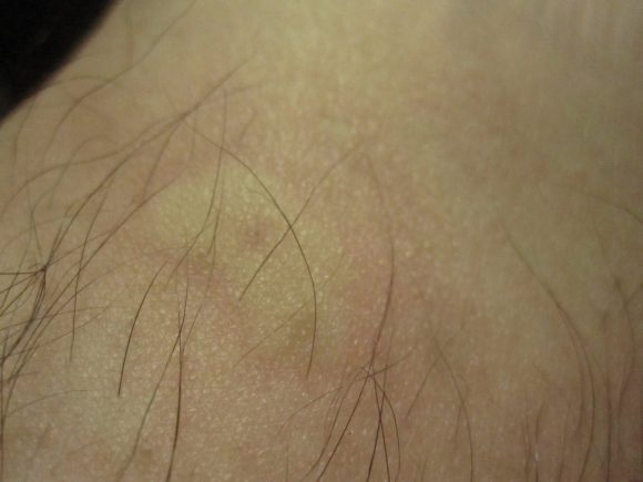 害虫の蚊（ヒトスジシマカ）に刺された跡が膨らんだ皮膚
