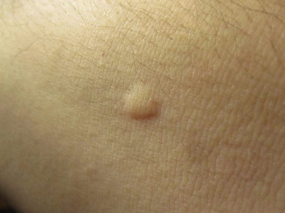 害虫の蚊（ヒトスジシマカ）に刺されてできた膨疹