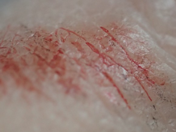 蚊を駆除した後の肌・皮膚の上に残った血痕と鱗粉（りんぷん）