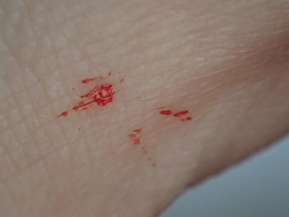 手の指に飛び散った蚊が吸った血液・血痕