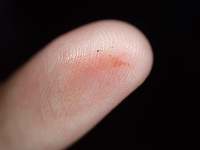 血を吸った蚊を退治した後、指に残った血痕