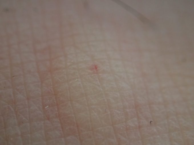 蚊に刺されて膨らんだ箇所に口器が開けた穴が小さく出血している