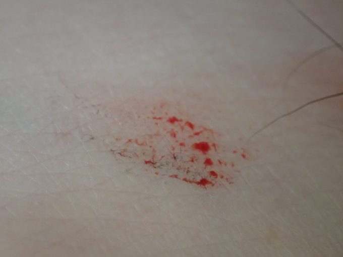 血を吸われた箇所”くるぶし”に自分の血がべっとりと残された