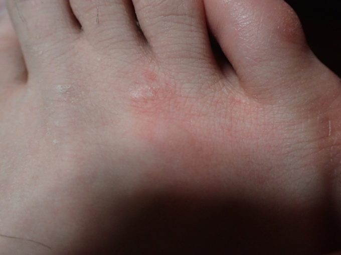 蚊に刺された足が赤く腫れ上がり痒みを生じている！