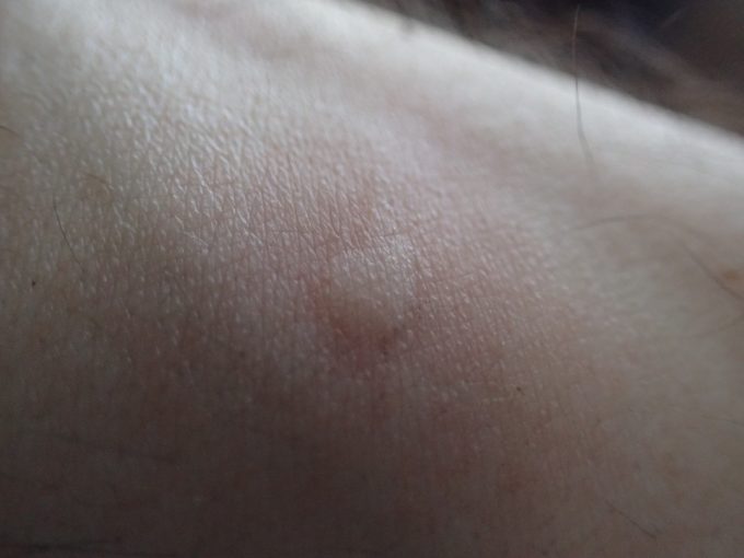 ヤブ蚊に血を吸われて蚊アレルギー症状で膨れて痒くなった膨疹