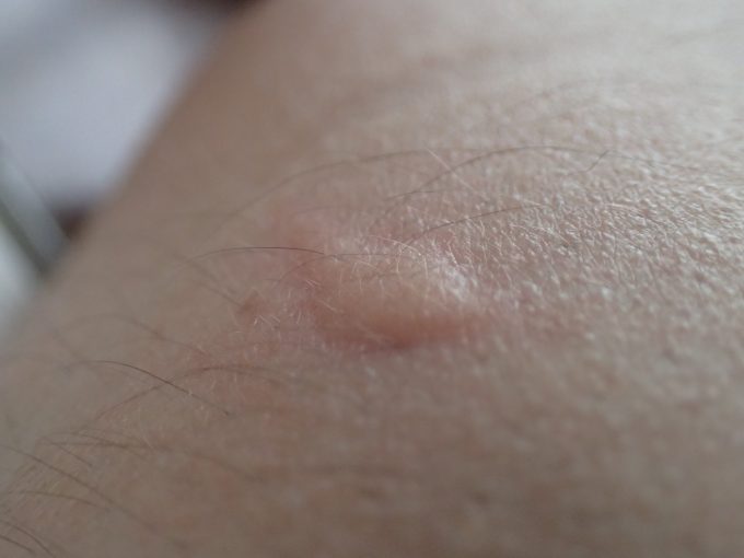 蚊に血を吸われてアレルギー症状で強い痒みが生じている皮膚