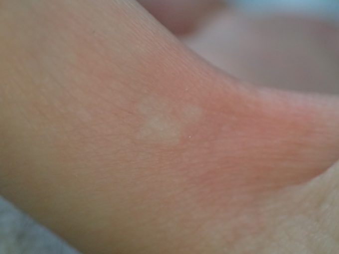 蚊に刺された箇所が膨疹状に腫れて痒みが生じる！