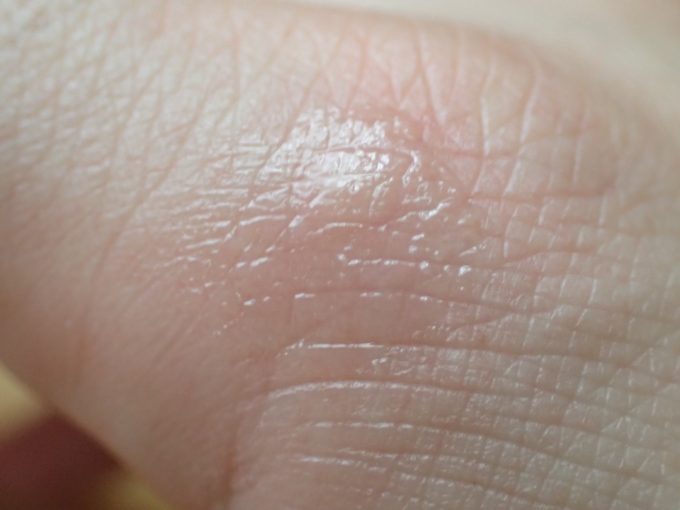 蚊に刺されて痒みを持った膨疹に軟膏剤を塗った肌