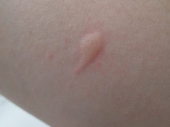 ”蚊いぶし”の準備中に蚊に刺されてしまった膨疹が激しい痒み