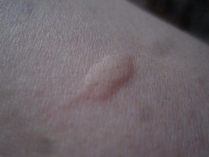 ボウフラ退治の「蚊とりん」を洗う作業中に蚊に刺された皮膚の画像（膨疹）