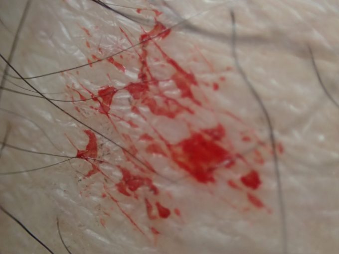 吸血箇所に残されたヒトの血液が乾いて”かさぶた”のように皮膚に残っている