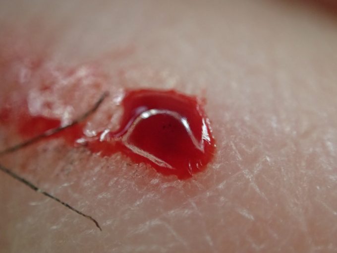 害虫ヒトスジシマカ（蚊）が吸い上げた血の塊