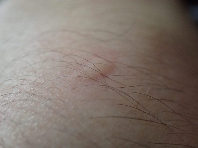 蚊に刺されて血を吸われた箇所の皮膚が膨らんだ写真