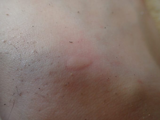 ヤブ蚊に刺され血を吸われた箇所が赤く膨らんで痒くなってきた