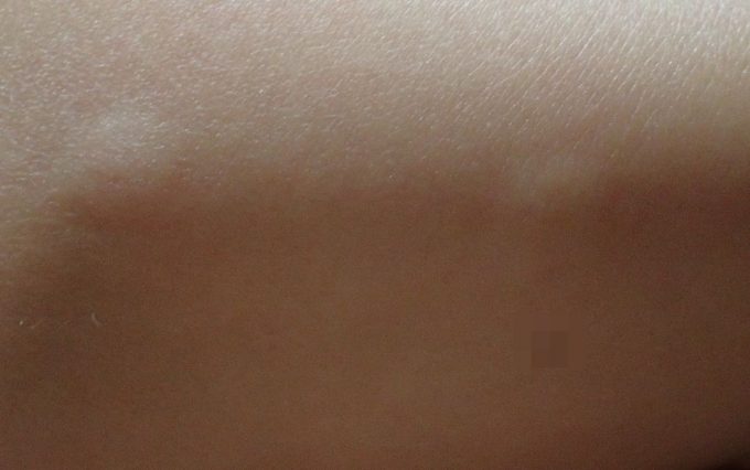 害虫の蚊に刺され血を吸われたらプックリ膨らんで痒くなってきた肌の写真