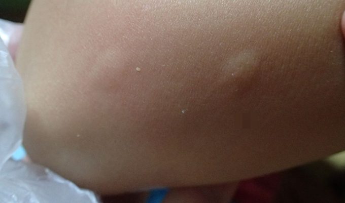 害虫の蚊に刺され血を吸われたらプックリ膨らんで痒くなってきた肌の写真