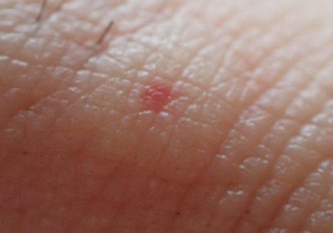 中心が赤く周囲の皮膚が盛り上がってズキズキとした痛みがする虫の刺され痕