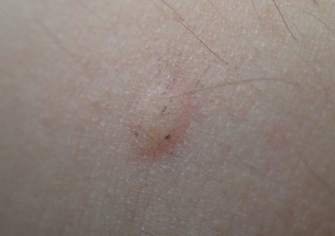 蚊に刺されて血を吸われた箇所がアレルギー反応で赤く腫れ膨らんで痒くなっている