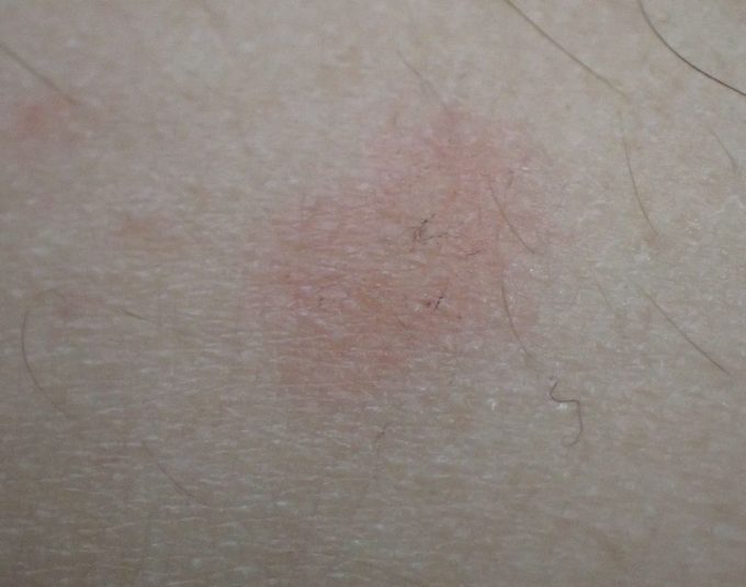 数分後、腫れも痒みも引いた蚊に血を吸われた箇所