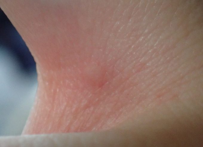 蚊に刺されて血を吸われた箇所がアレルギー反応で膨れ痒くなった